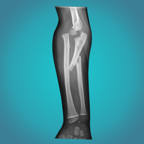 Post Fracture Rehabilitation Treatment in Ahmedabad